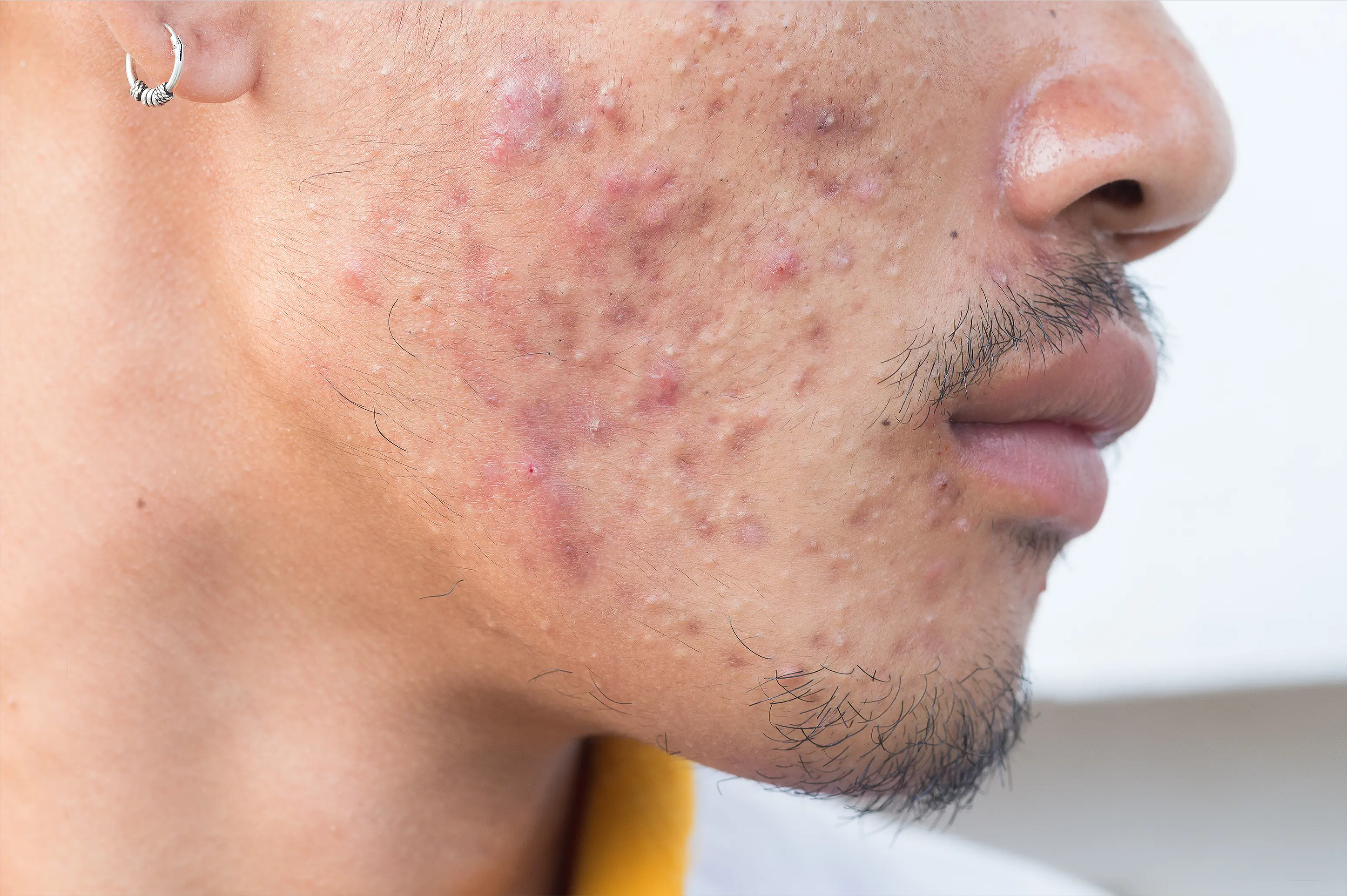 Understanding and Treating Acne: A Clinical Perspective