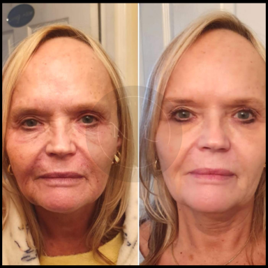 skin booster  nurse lee cosmetics polynucloetides west midlands Black Country 