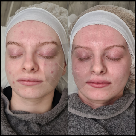 A before-and-after comparison of a woman's face, showcasing skin improvement after skin booster injections. Redditch West Midlands