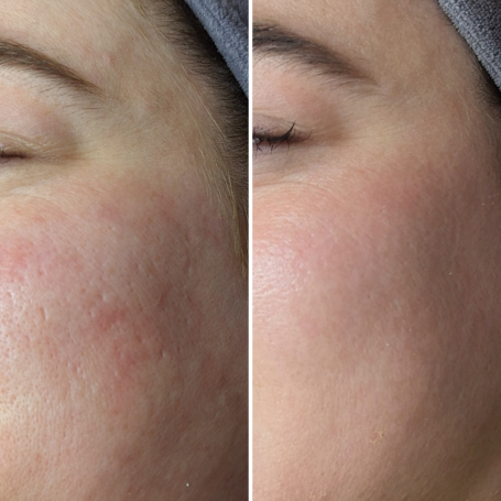 skin texture improvement with microneedling