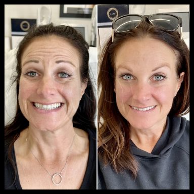 botox anti-wrinkle nurse lee cosmetics wrinkle relaxing west midlands Black Country 