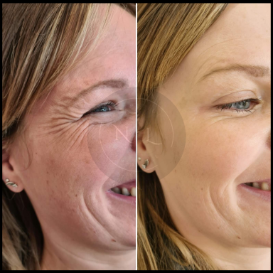 botox anti wrinkle injections nurse lee cosmetics wrinkle relaxing west midlands Black Country 