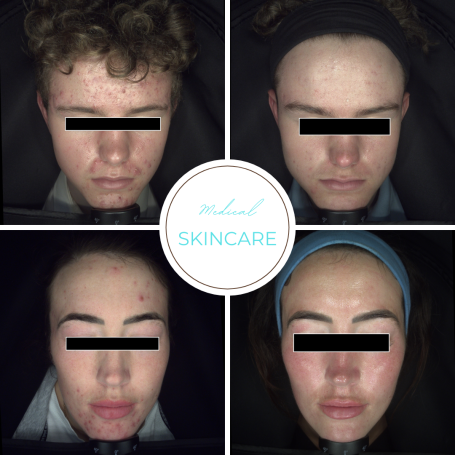 Collage of four individuals with various skin conditions and facial expressions.