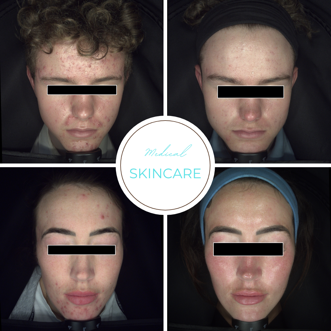 Nurse Lee Cosmetics Medical Skincare Botox Dermal Fillers Skin Boosters Skin Treatment Acne Treatment Halesowen