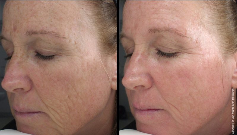 Before and after comparison of facial skin showing wrinkles and texture improvement.