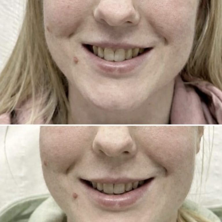 Botox Halesowen Birmingham Stourbridge Dudley Kingswinford Kidderminster 