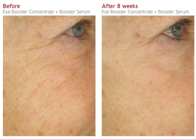 Close-up of an eye area showing skin improvement before and after using a serum.