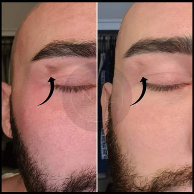 microneedling nurse lee cosmetics skin peel scar reduction west midlands Black Country 