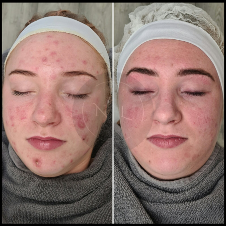 A before-and-after comparison of a woman's face, showcasing skin improvement after a treatment. Halesowen West Midlands