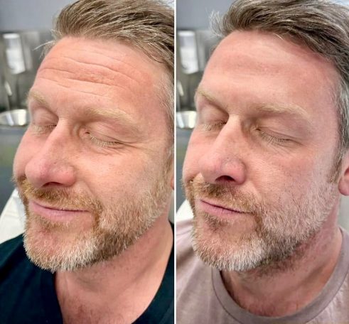 A before-and-after comparison of a man's face, showcasing skin improvement after aesthetic treatment. Wolverhampton West Midlands