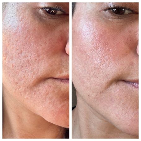 scar revision with microneedling