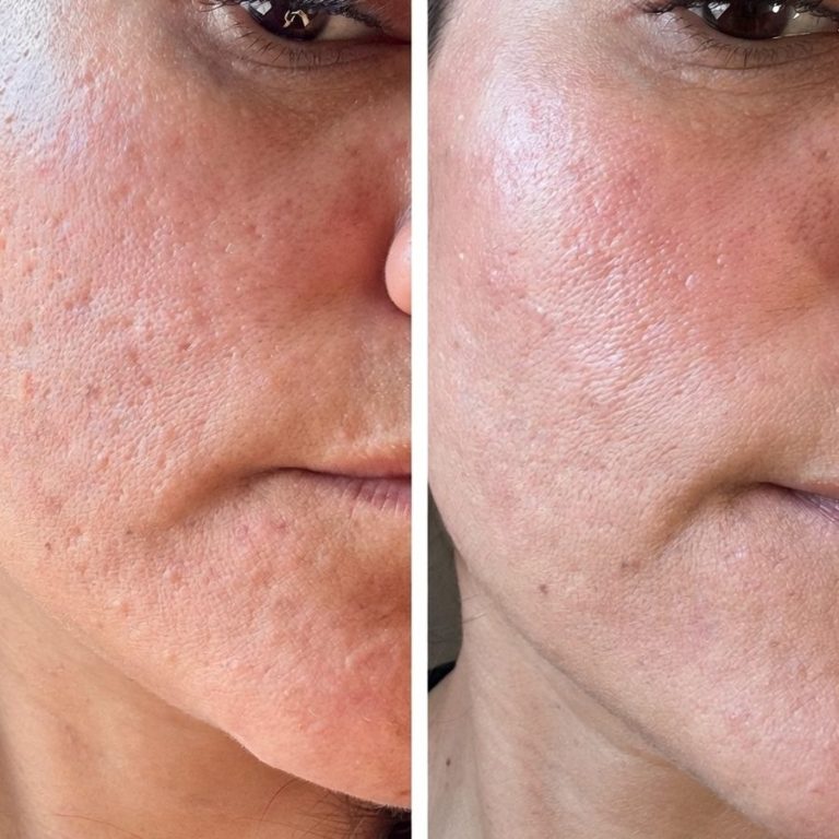 Microneedling Halesowen Birmingham Stourbridge Dudley Kingswinford Kidderminster 