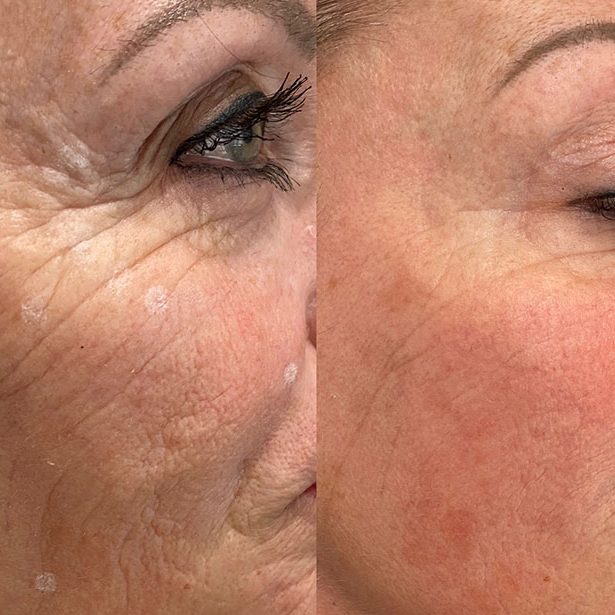 Skin Boosters Halesowen Birmingham Stourbridge Dudley Kingswinford Kidderminster 