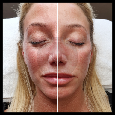 cheek filler nurse lee cosmetics dermal filler skin booster profhilo west midlands Black Country 