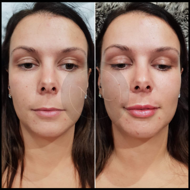 lip fillers nurse lee cosmetics dermal filler west midlands Black Country 