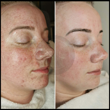 microneedling skincare chemical peel nurse lee cosmetics west midlands Black Country 
