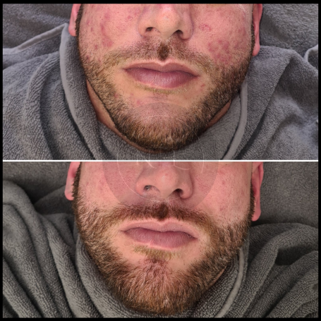 A before-and-after comparison of a man's face, showcasing skin improvement after a treatment. Kingswinford West Midlands