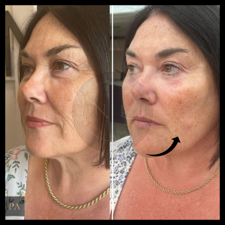 A before-and-after comparison of a woman's face, showcasing skin improvement after polynucleotides. Halesowen West Midlands