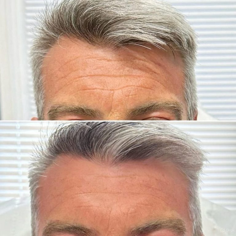 Botox Halesowen Birmingham Stourbridge Dudley Kingswinford Kidderminster 