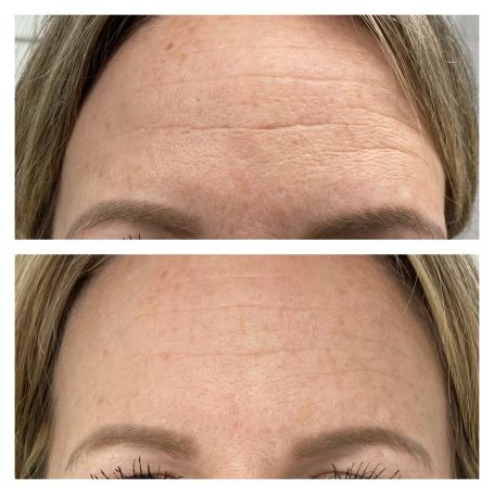 static line improvement with microneedling