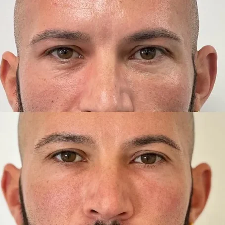 A before-and-after comparison of a man's face, showcasing skin improvement after polynucleotides. Rowley Regis West Midlands