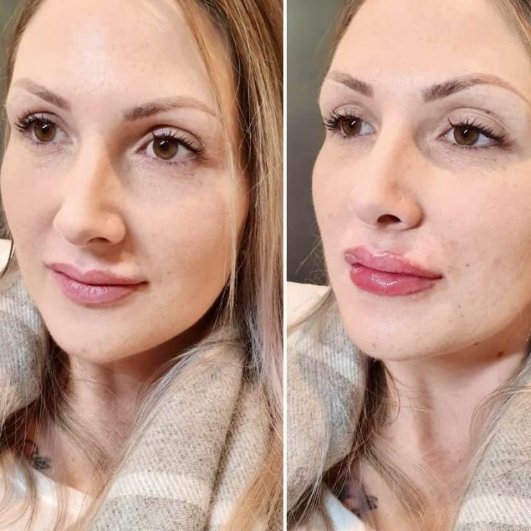 Dermal Filler Halesowen Birmingham Stourbridge Dudley Kingswinford Kidderminster 